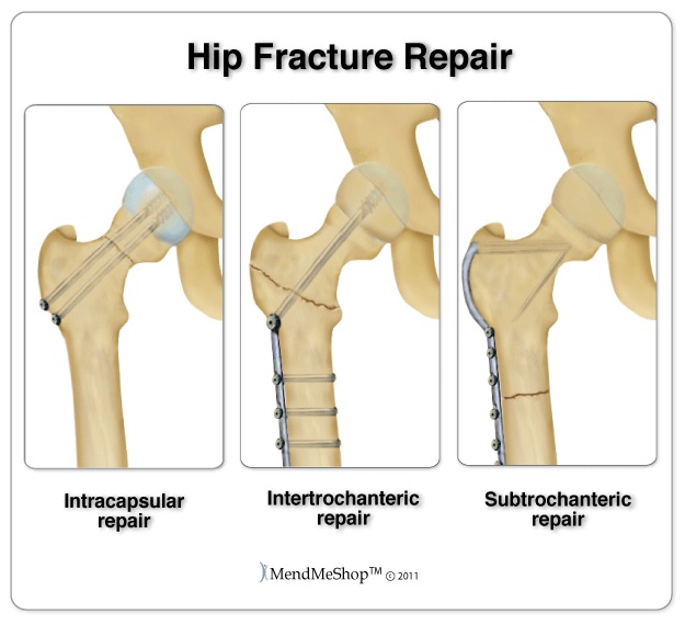 Hip fracture repairs ofter require pins and screws to secure the broken femur to the hip joint.