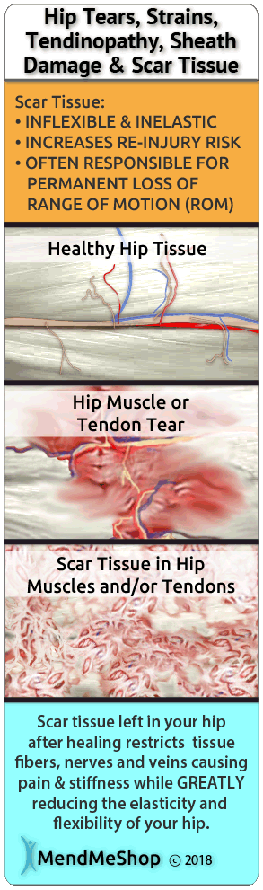 hip ligament and tendon tissue tears heal with scar tissue - brittle, inflexible and painful