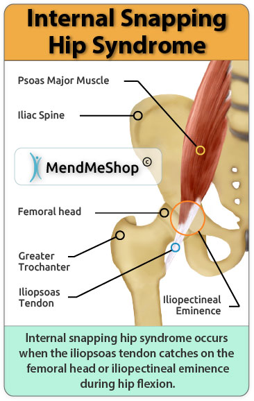 Internal snapping hip syndrome occurs when the iliopsoas tendon catches on the femoral head or iliopectineal eminence.