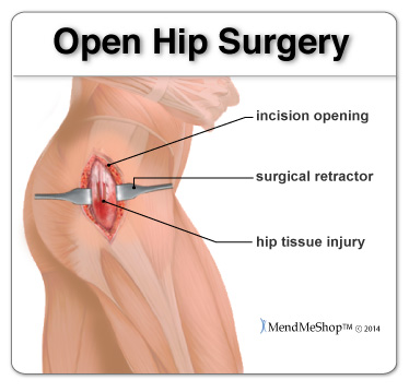 open hip surgery and what happens