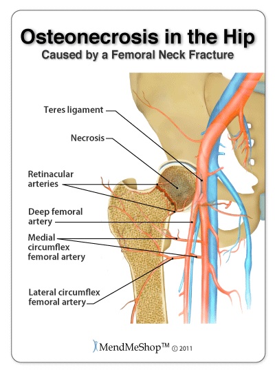 Hip Osteonecrosis Information Treatment